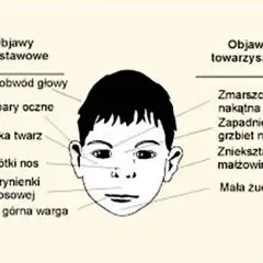 Ilustracja przedstawia twarz dziecka z zaznaczonymi cechami zespołu FAS: mały obwód głowy, płaska twarz, krótki nos, wąska górna warga, zmarszczka nakątna, zapadnięty grzbiet nosa.