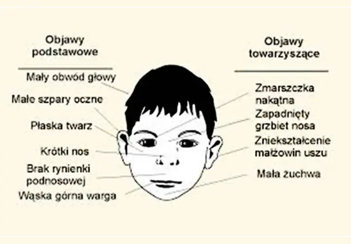 Ilustracja przedstawia twarz dziecka z zaznaczonymi cechami zespołu FAS: mały obwód głowy, płaska twarz, krótki nos, wąska górna warga, zmarszczka nakątna, zapadnięty grzbiet nosa.