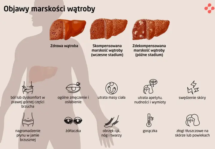 Objawy marskości wątroby: ból brzucha, zmęczenie, utrata masy ciała, żółtaczka, obrzęki, gorączka, swędzenie skóry.