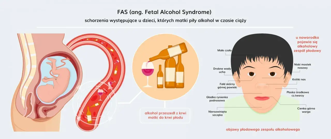 Ilustracja pokazuje płód w łonie matki, butelki alkoholu i dziecko z cechami FAS. Alkohol przechodzi z krwi matki do krwi płodu, powodując alkoholowy zespół płodowy.