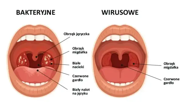 Ból gardła po amfetaminie: przyczyny, objawy i jak szybko przynieść ulgę